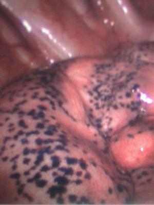 lungs image